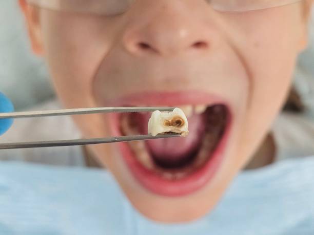 Best Broken or Chipped Tooth Repair in Pupukea, HI